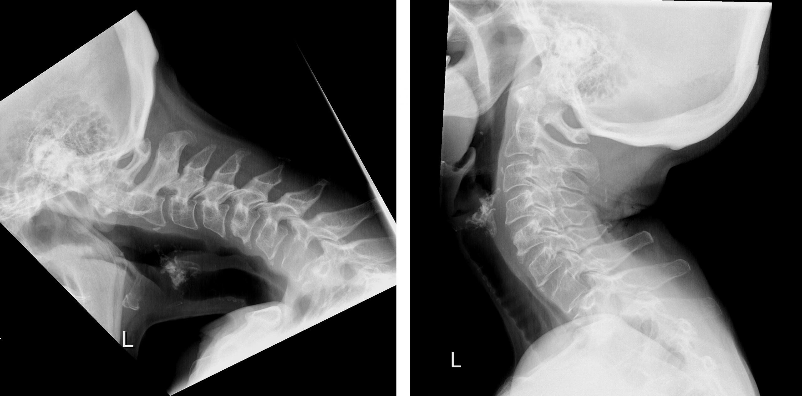 New surgical technology avoids reinforcing vertebrae